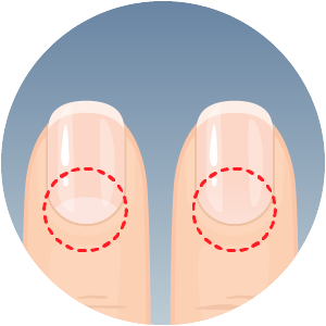 all-tenet-fingernails-clue-300x300-2024-01 Fingernails showing possible clubbing symptoms
