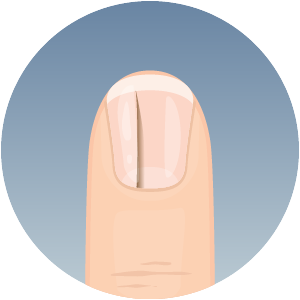 all-tenet-fingernails-clue-300x300-2024-03 Fingernail with vertical ridge abnormality